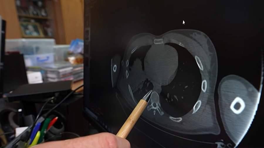 Врачи провели бойцам СВО уникальные операции по удалению осколков из легких