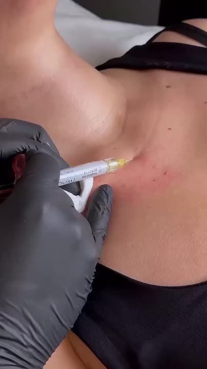 Кольца Венеры на шее — это горизонтальные морщины, которые появляются на коже шеи у многих людей