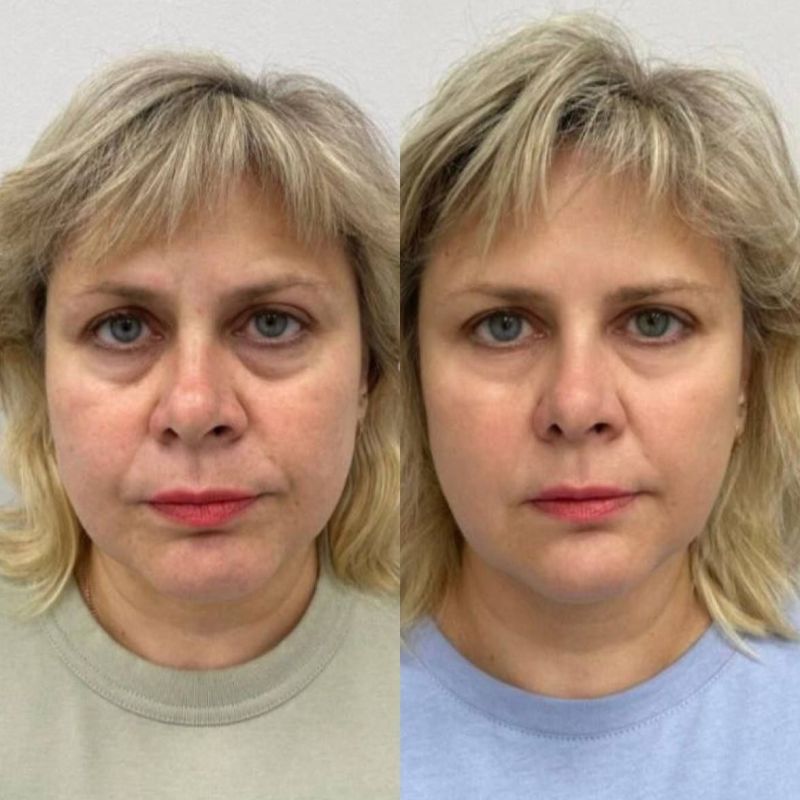 RF-лифтинг для лица!. Мощный аппарат нового поколения уже в работе — и даёт быстрые и заметные результаты Без боли, без уколов, без реабилитации