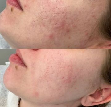 Для мгновенного обновления и ровного тона: Нежные пилинги и чистки, которые деликатно отшелушат кожу, вернут ей гладкость и здоровый румянец