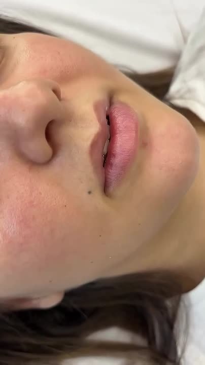 311111164. Контурная пластика губ Многие до сих пор думают, что контурная пластика губ = большие и «кукольные» губы