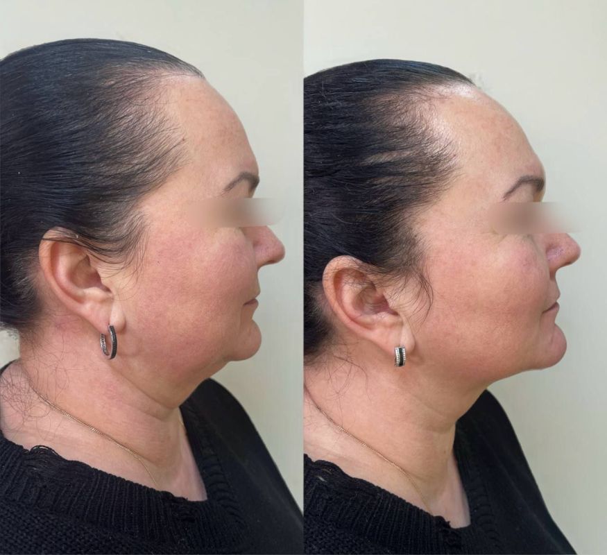 311111165. BioGEL ����������ܻ