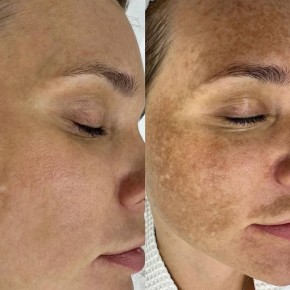 Пигментация -проблема, которая часто нас беспокоит, заставляет наносить тонны тонального крема и чувствовать себя неуверенными в себе Главные провокаторы пигментации : солнце, возраст, гормональные качели, агрессивные...