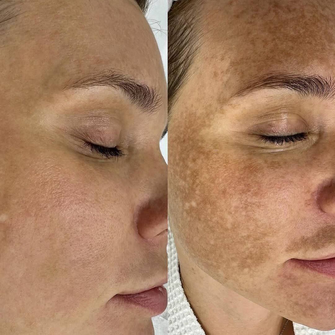 Пигментация -проблема, которая часто нас беспокоит, заставляет наносить тонны тонального крема и чувствовать себя неуверенными в себе Главные провокаторы пигментации : солнце, возраст, гормональные качели, агрессивные...