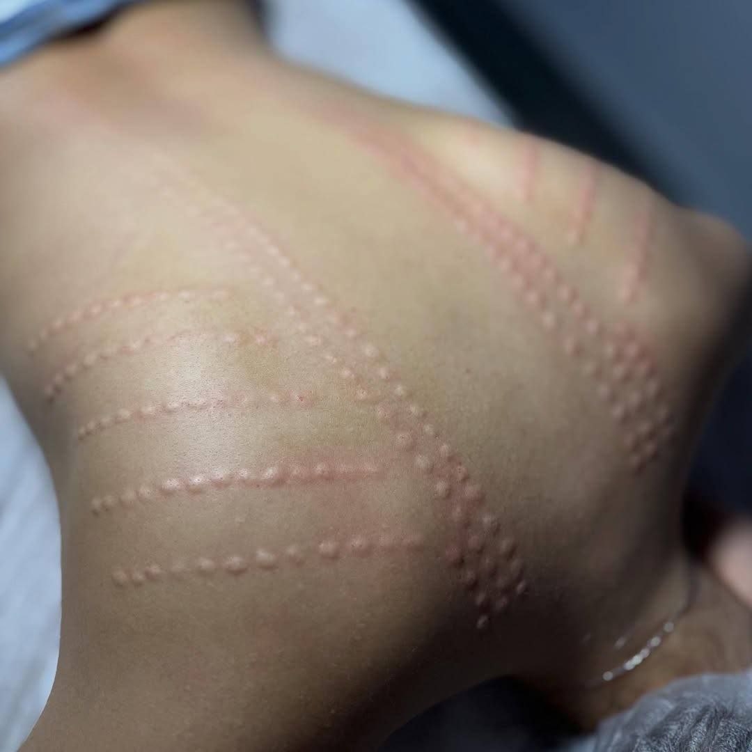 Сосудистый этап — неотъемлемая часть комплексного подхода к коррекции фигуры